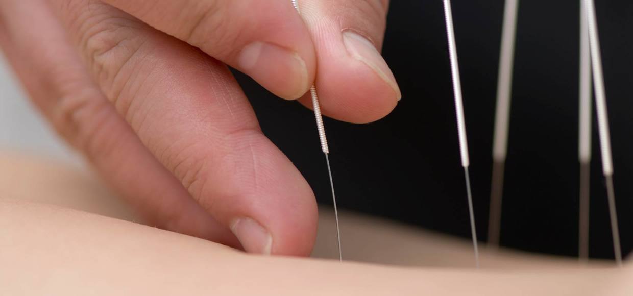 dryneedling